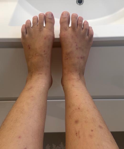 ¿I was itching myself to death every night ¿ doctors thought I needed moisturiser, but it turned out to be far more sinister¿