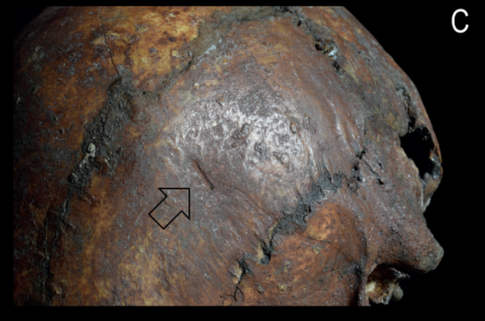 Skull fragment with an arrow pointing to a small, linear cut mark.