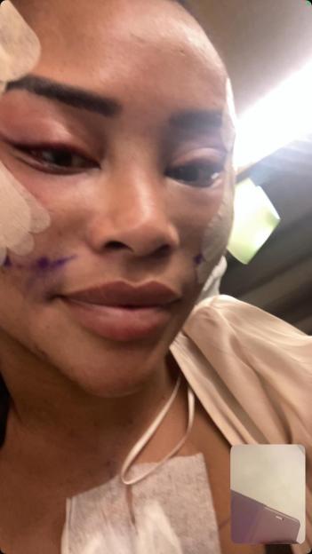 A person's face with surgical markings and bandages, indicating a cosmetic procedure.