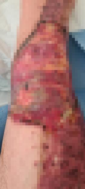 The partially pixelated image shows severe burns on a person's legs.