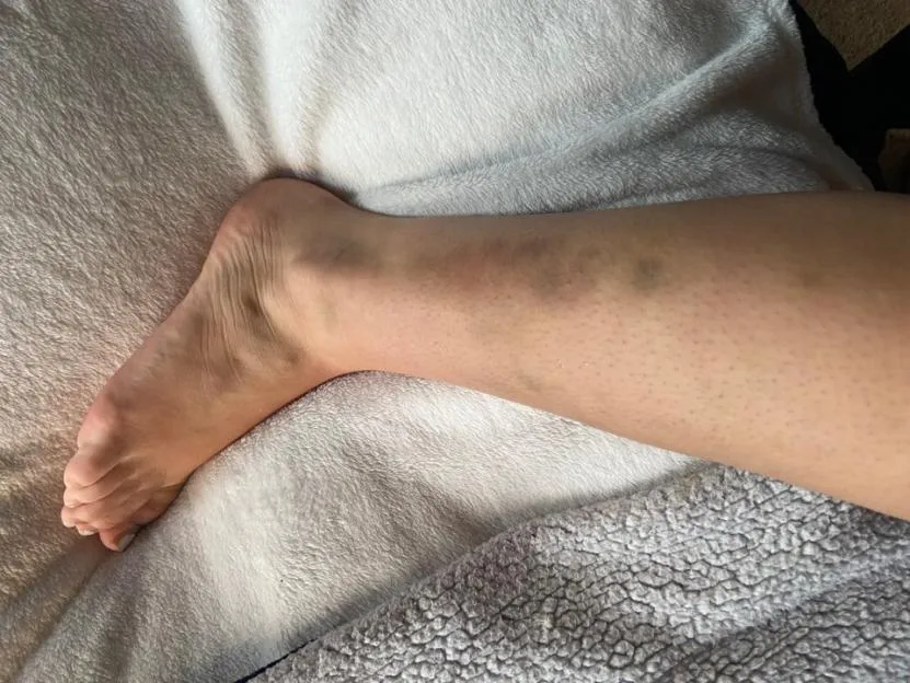 'Monster boyfriend left me traumatised, covered in bite marks and £12k in debt'