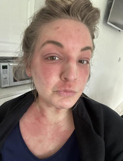 A woman with red, irritated skin and flaky lips due to Topical Steroid Withdrawal (TSW).