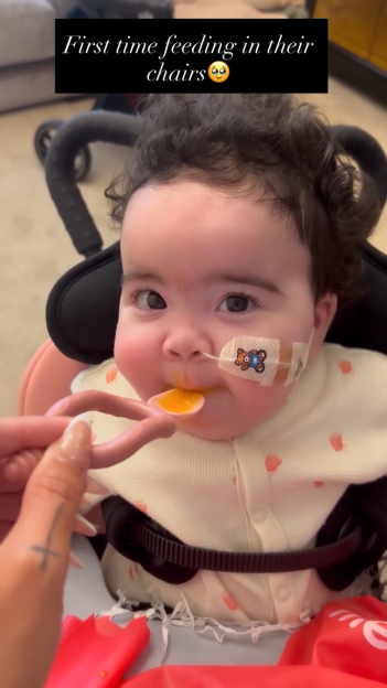 Baby with a feeding tube being fed from a spoon, sitting in a highchair.