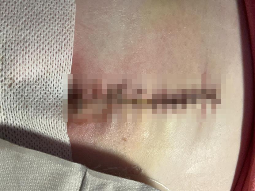 'Doctors removed my vulva and bum after horror cancer ravaged my body  it started with itching that left me feeling on fire'