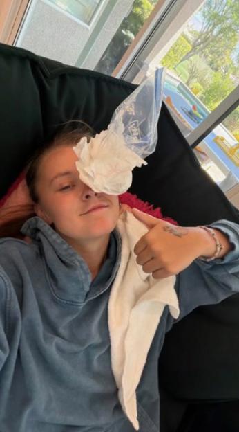 Jojo Siwa laying down with an ice pack on her eye, giving a thumbs up.