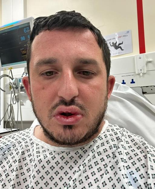 Man in a hospital gown, with an injured mouth, doused in a substance.