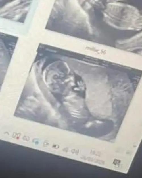 A close-up of a fetus during an ultrasound on a computer screen.