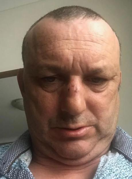 Darts Champion Competes with a Broken Nose After Brutal Headbutt in Shocking Case of Mistaken Identity