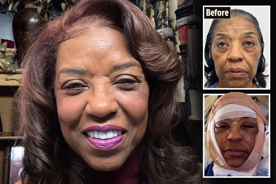 'At 71, I Treated Myself to a £77k Facelift with My Late Husband's Inheritance – Friends Were Envious of My Choice!'