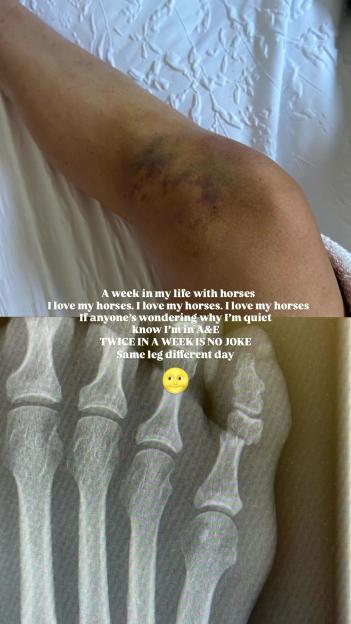 'Love Island's Faye Winter Admitted to Hospital Again in Just a Week, Shows Off Swollen and Bruised Leg'