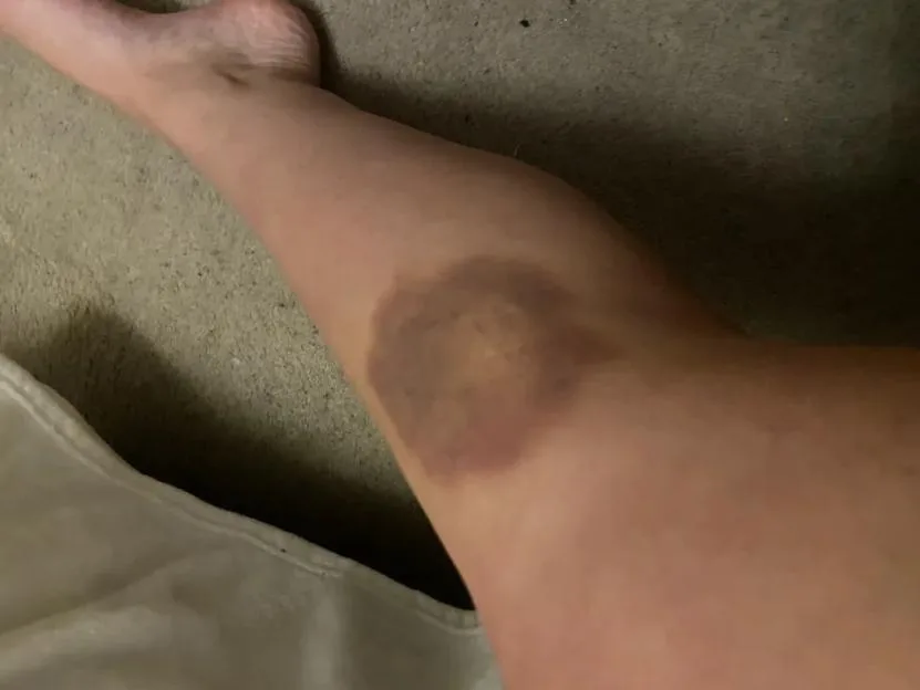 'Monster boyfriend left me traumatised, covered in bite marks and £12k in debt'