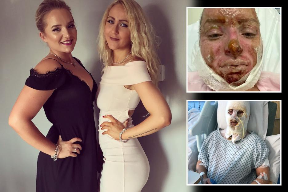 Cousins Endure Terrifying Burns After Friend Accidentally Ignites Pub Heater with Fuel
