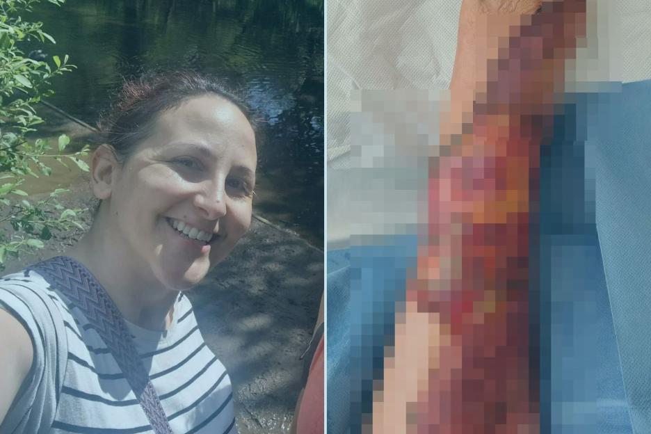 Holidaymaker unable to walk for 18 months after seizure in hot shower left her with severe burns down to her BONES