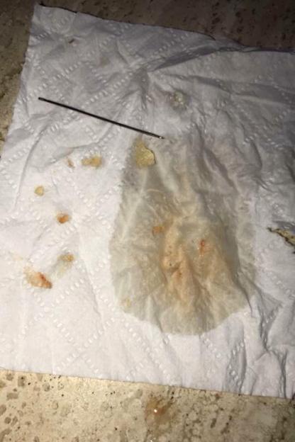 Tissue with removed lip filler, a needle, and small spots of dried blood.