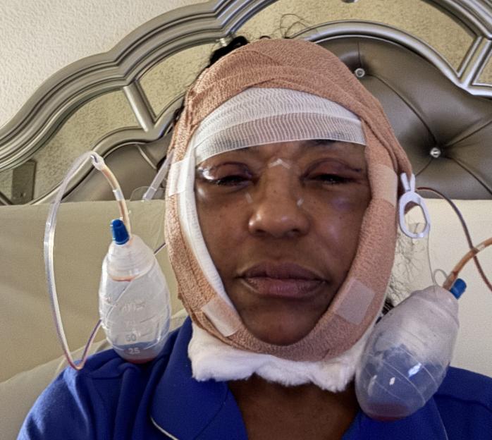 A person with bandages and drainage tubes on their head and face after surgery.