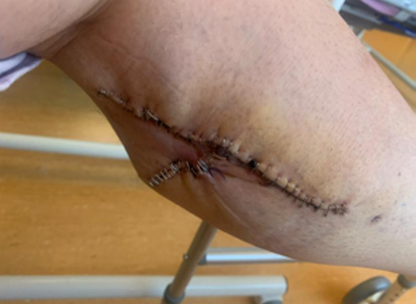 Elaine Sawyer's leg after surgery for tongue cancer, showing stitches on her thigh where skin was removed.