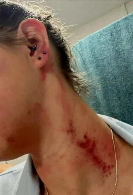 Hayleigh Allsopp's injuries.