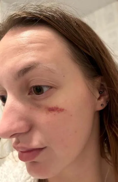 Hayleigh Allsopp's visible injury on her face.