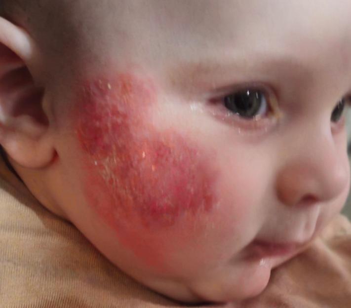 'My Son Suffered Severe Skin Reactions for Months After Using 'Baby-Friendly' Fairy Detergent'