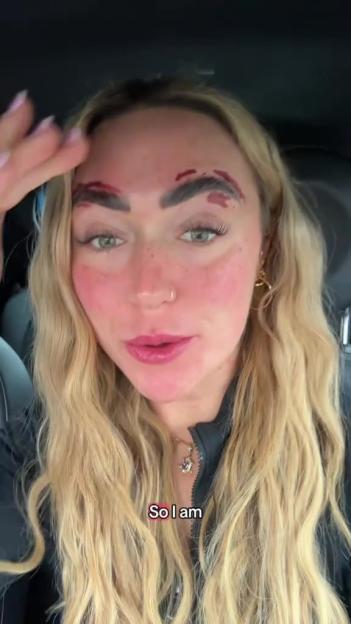 A woman with red irritated skin and pieces of eyebrow wax stuck to her eyebrows.