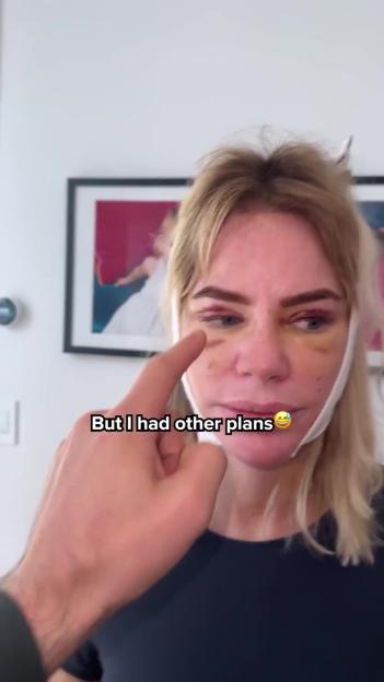 Reality Star Ex of Andrew Reveals Facelift Scars and a Swollen Face After Surgery