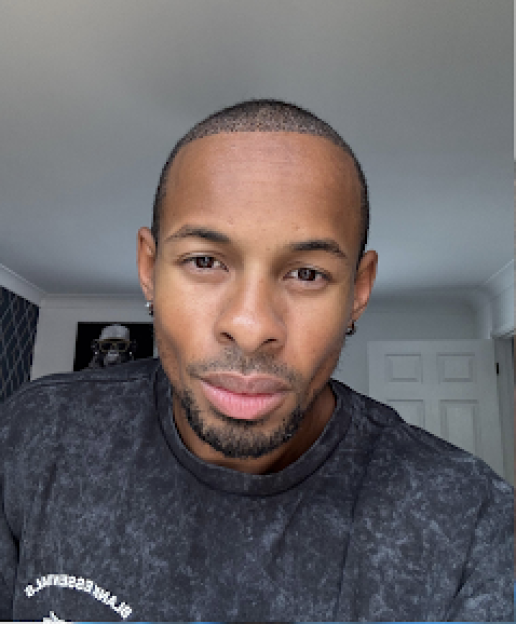Konnor, a Love Island contestant, with a recently transplanted hairline.