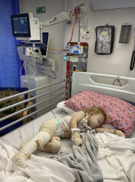 A toddler in a hospital bed with bandaged limbs, likely from burns.