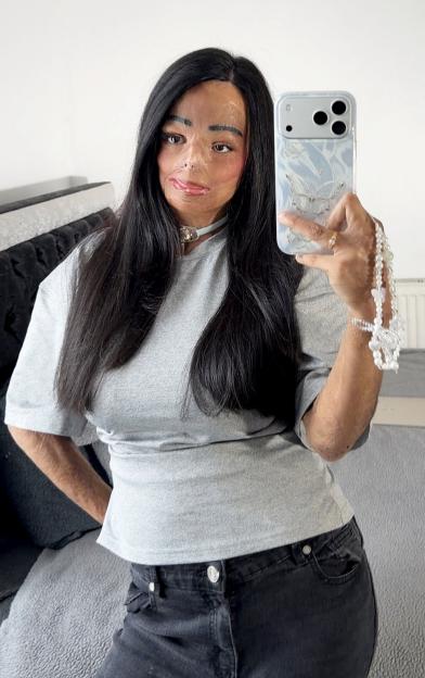 Schoolgirl, 12 left with horrific burns on half her body after shampoo catches fire