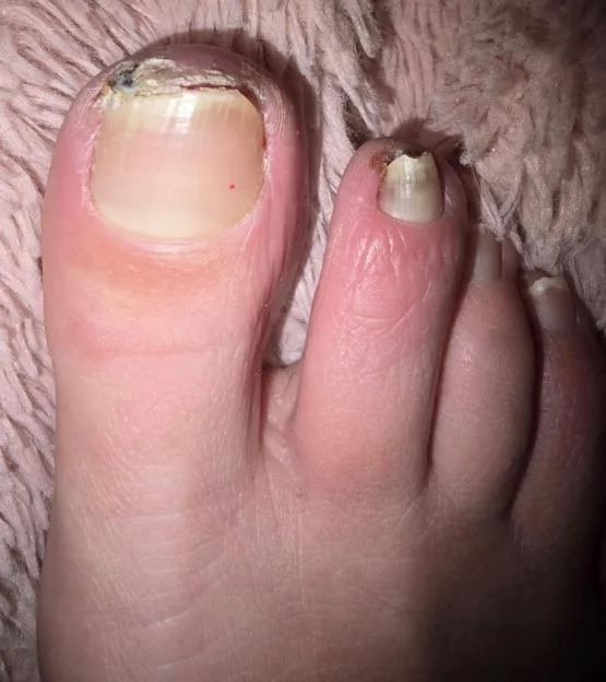Close-up of a foot showing discolored and damaged toenails.