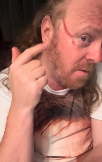 Leigh Francis with a red scar from his eye to his temple.
