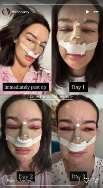 MAFS UK star Rebecca Fenney shares nose job regrets just two weeks after surgery