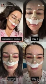 MAFS UK star Rebecca Fenney shares nose job regrets just two weeks after surgery