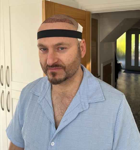 A man with a shaved head and a black headband wears a light blue shirt after a hair transplant.