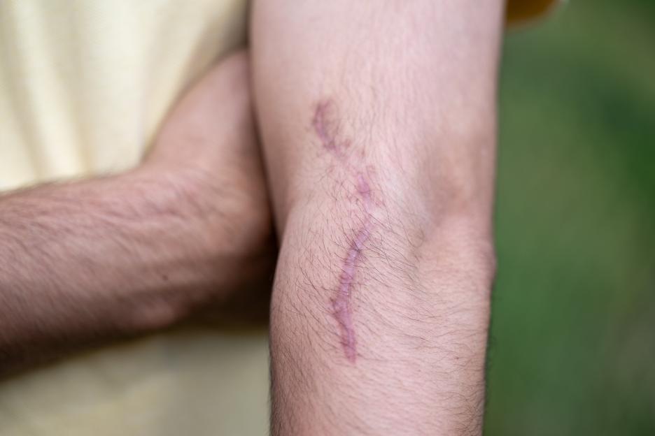 A close-up of Raza Aslam's left arm, showing a faded, pinkish scar running down his forearm.