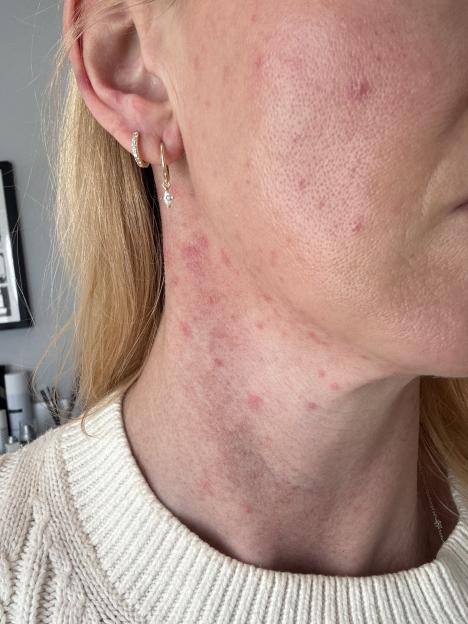 Close-up of a person's neck and jawline with a red, blotchy rash.