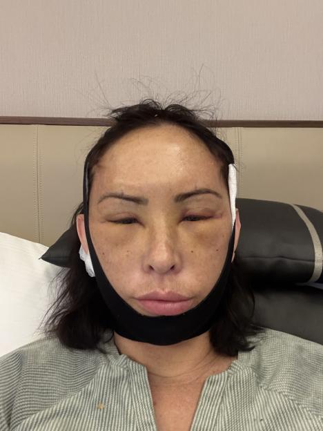 Jojo McGinniss with bruising and swelling on her face and a black compression band around her chin and jawline after surgery.