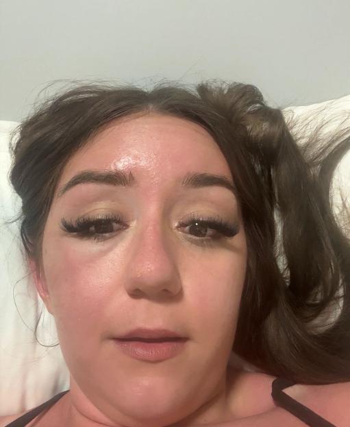 Holiday horror as Brit¿s ¿eye bags¿ lead to mystery illness ¿ trapping her in Greek hospital
