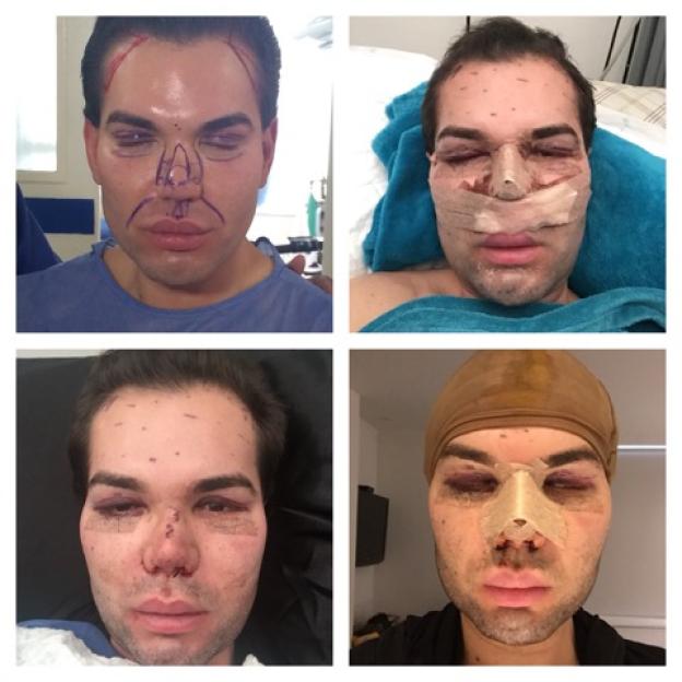 Collage of four images showing Rodrigo Alves's face during and after plastic surgery on his nose, with swelling, bruising, and bandages visible.