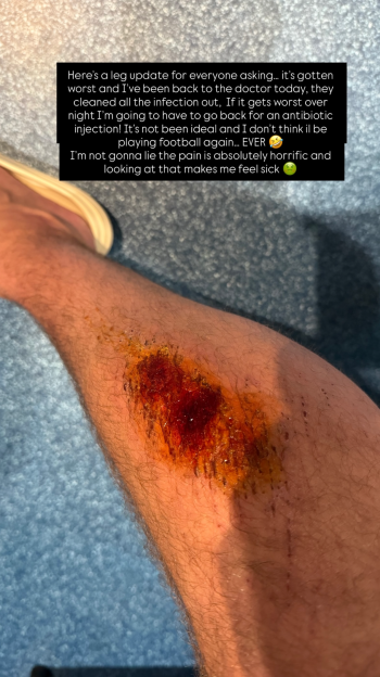 Charlotte Crosby's fiancé Jake Ankers shares alarming update on his worsening infection after emergency hospitalization in Dubai