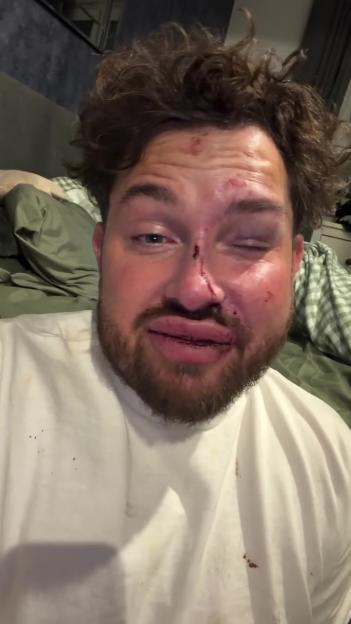 'Married at First Sight Star Opens Up About Attack: Shows Off Black Eye and Bruises'