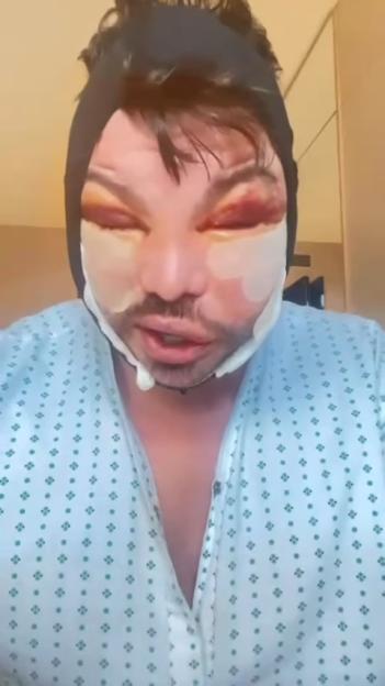 A man with a black headband, bruising around his eyes, and bandages on his cheeks, wearing a hospital gown.