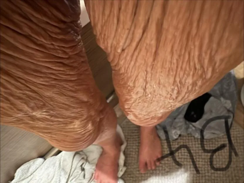 A person's legs with significant loose skin after losing a large amount of weight.