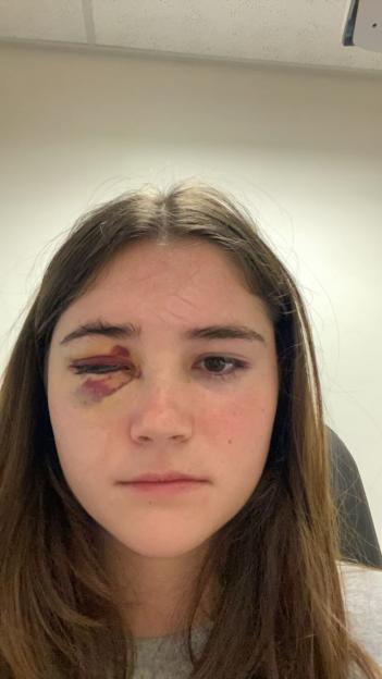 I lost my eye due to a rare cancer  I felt sick to my stomach when I looked in the mirror after surgery