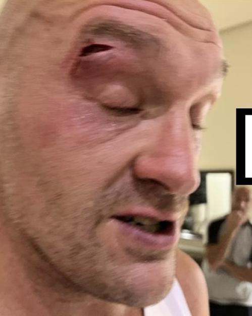 'Tyson Fury Hospitalized After Ex-Sparring Partner Exposes 'Horrific Treatment''