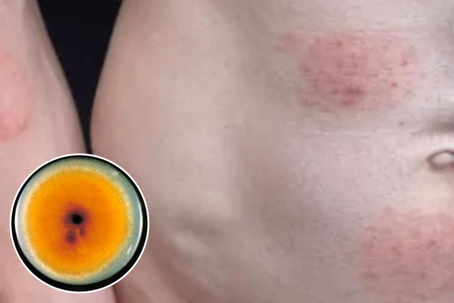 Experts Alert: 'Highly Contagious Fungal Worm' Spread Through Sex Could Be Surging Silently in the UK