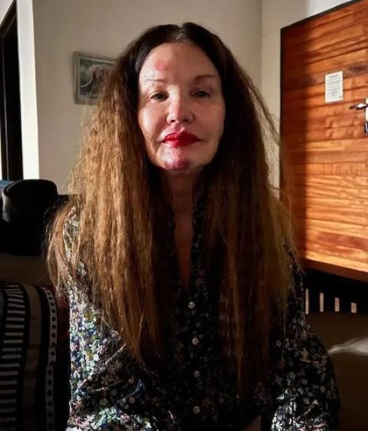 Janice Dickinson showing injuries to her face, particularly around her mouth and forehead.