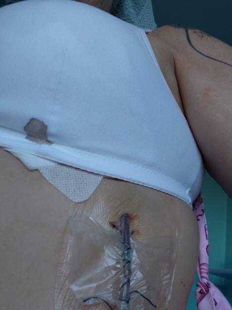 Close-up of a patient's torso wearing a white sports bra, showing a wound with stitches and a clear dressing, with a drainage tube coming out of it.