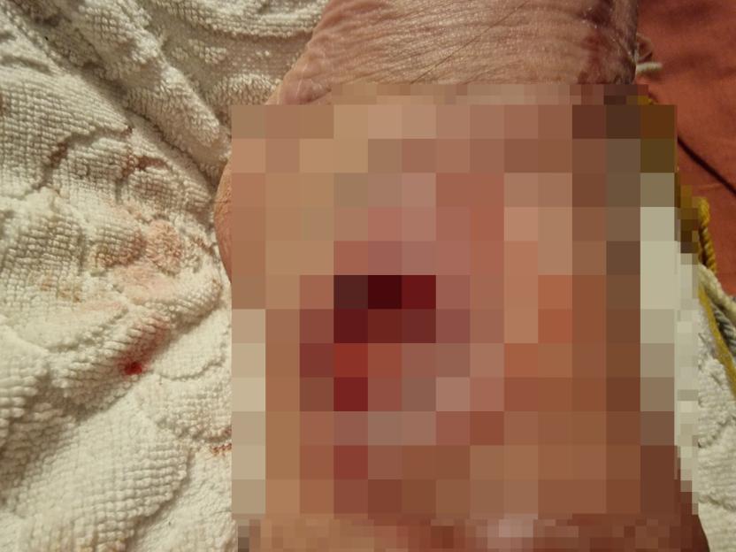 Close-up of a severe burn on an ankle.