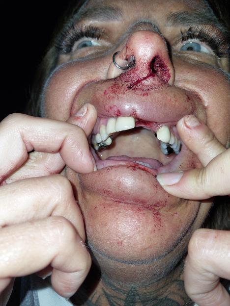 A close-up of Kelly Prosser's face after an assault, showing a bloody nose, swollen lips, missing front teeth, and cuts around her mouth.