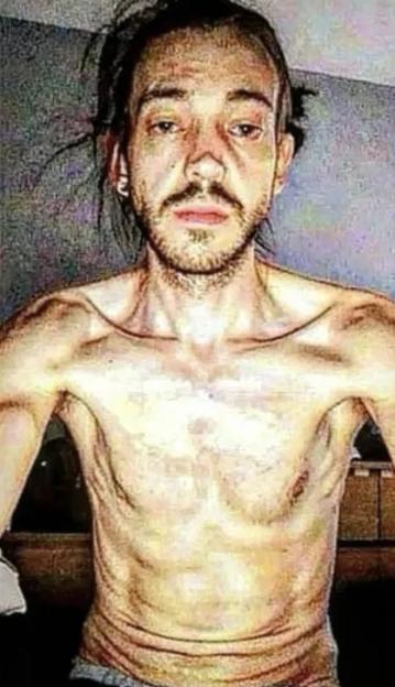 Collage of a man's physical transformation from emaciated to healthy.